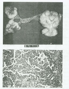 بيماريهاي تخمدان و لوله هاي رحمي چیست؟(1)
